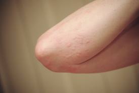 Irritating Skin Rashes: 13 Possible Causes | ActiveBeat